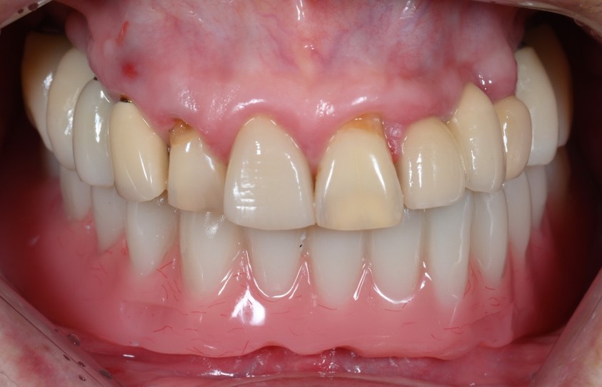 한솔치과기공소 작품 3